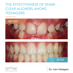 Efficacite du systeme d‘aligneurs spark dans le traitement des adolescents
