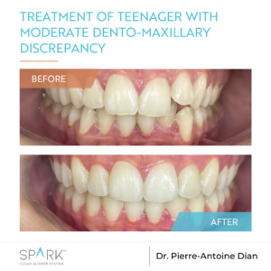 Traitement de la dysharmonie dento- maxillaire modérée chez une adolescente – Spark™