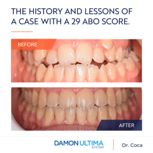 Damon Clear™ et Damon Ultima™ – l’histoire et les enseignements d’un cas avec un score ABO de 29
