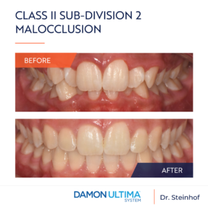 Malocclusion de classe II, sous-division 2, avec un encombrement maxillaire et mandibulaire important